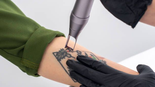 That tattoo made sense at the time. Removing it in Dubai is simpler than you think.