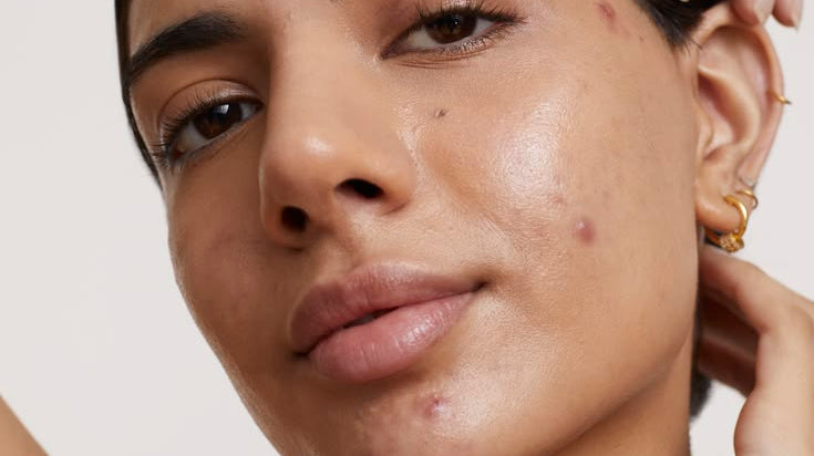 Teenage acne in Dubai is common. Letting it scar doesn't have to be.
