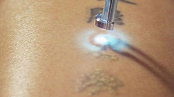 Tattoos are permanent — until the right laser changes that.