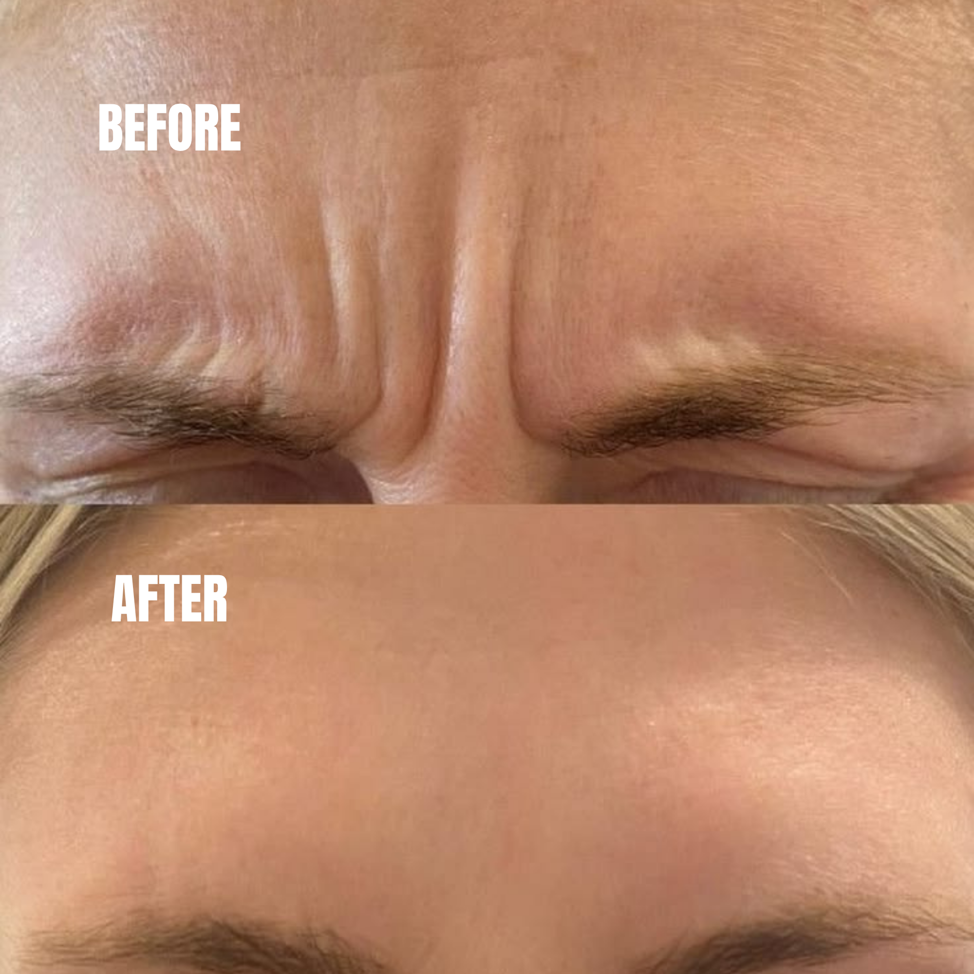 Close-up of Botox injection procedure for forehead lines and wrinkles