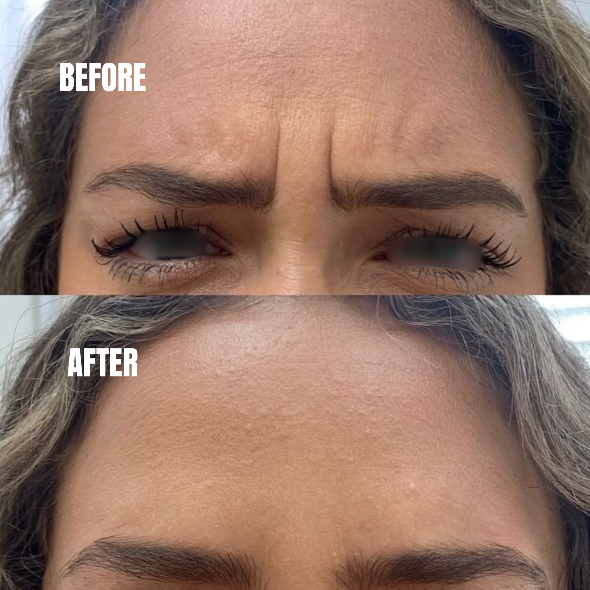Botox for frown lines between eyebrows creating smoother expression