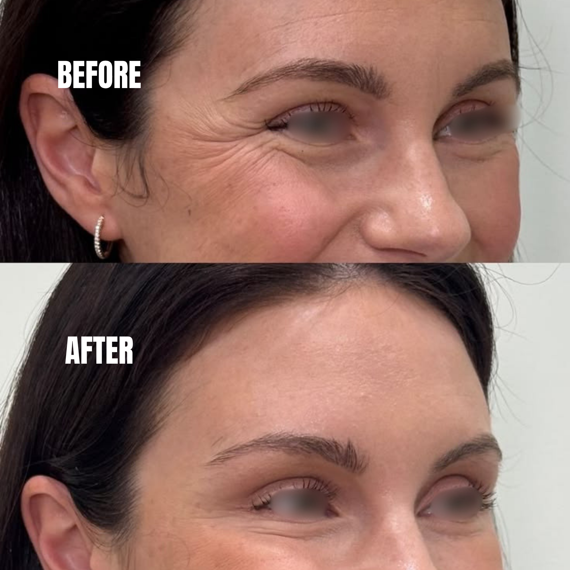 Natural Botox results showing smoother forehead lines and refreshed in Dubaiappearance