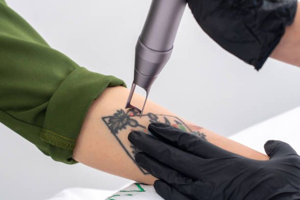 That tattoo made sense at the time. Removing it in Dubai is simpler than you think.
