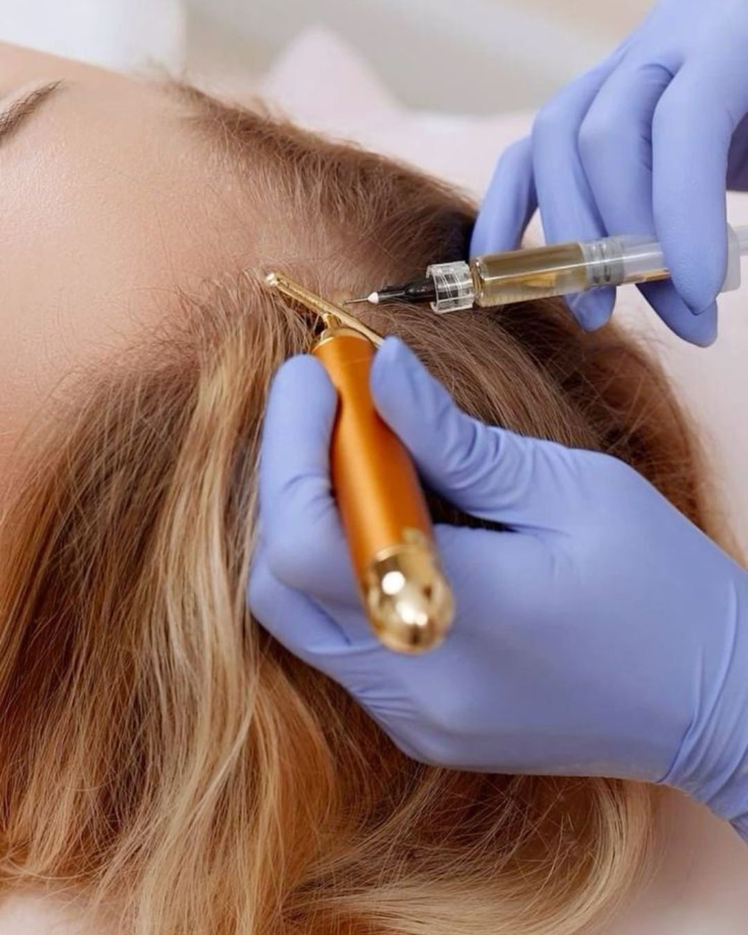 Hair loss in Dubai is not just genetics. And it deserves more than a generic fix.