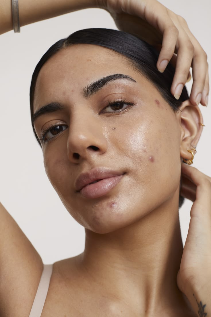 Teenage acne in Dubai is common. Letting it scar doesn't have to be.