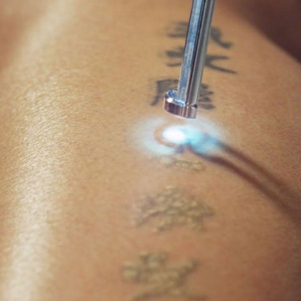 Tattoos are permanent — until the right laser changes that.