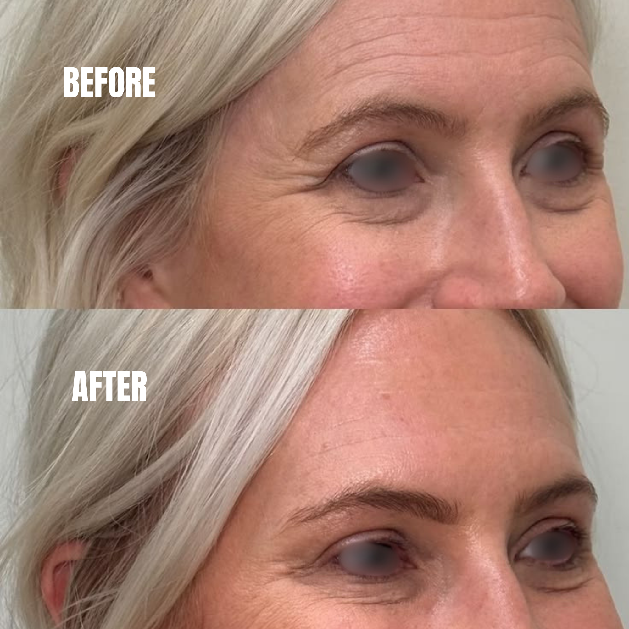 Botox treatment for forehead lines and anti-aging results