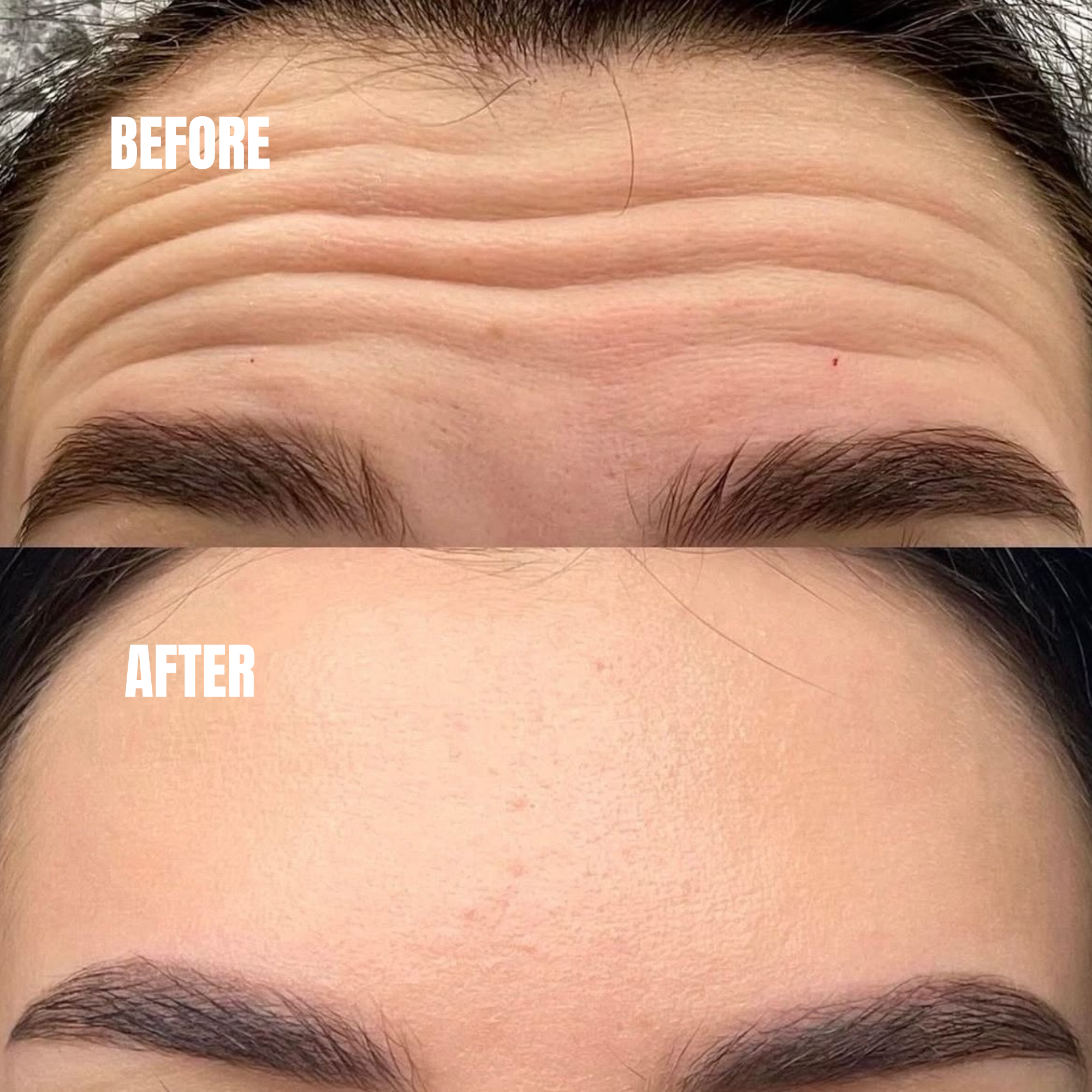Before and after Botox treatment reducing frown lines and wrinkles in Dubai